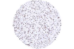 Clear cell renal cell carcinoma with strong Histone H3 staining of tumor cells