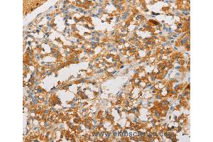 Immunohistochemistry of Human lung cancer using ART3 Polyclonal Antibody at dilution of 1:40