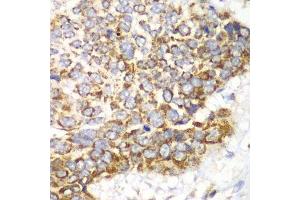 Immunohistochemistry of paraffin-embedded human esophageal cancer using TFAM antibody. (TFAM anticorps  (AA 1-220))