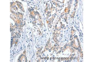 Immunohistochemistry of Human colon cancer using ALPP Polyclonal Antibody at dilution of 1:50 (PLAP anticorps)
