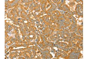 The image on the left is immunohistochemistry of paraffin-embedded Human thyroid cancer tissue using ABIN7130772(PTPN22 Antibody) at dilution 1/30, on the right is treated with fusion protein. (PTPN22 anticorps)
