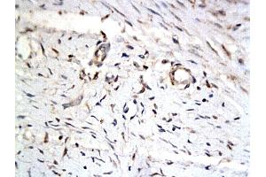 Formalin-fixed and paraffin embedded keloid tissue labeled with Anti-iASPP Polyclonal Antibody, Unconjugated (ABIN727280) followed by conjugation to the secondary antibody and DAB staining