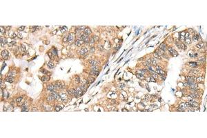 Immunohistochemistry of paraffin-embedded Human gastric cancer tissue using BLNK Polyclonal Antibody at dilution of 1:40(x200)