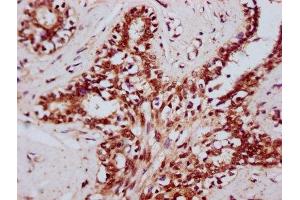 IHC image of ABIN7164169 diluted at 1:400 and staining in paraffin-embedded human breast cancer performed on a Leica BondTM system. (DHX38 anticorps  (AA 113-280))
