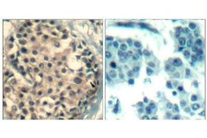 Immunohistochemical analysis of paraffin-embedded human breast carcinoma tissue using HDAC4/HDAC5/HDAC9(Phospho-Ser246/259/220) Antibody(left) or the same antibody preincubated with blocking peptide(right). (HDAC4/HDAC5/HDAC9 anticorps  (pSer220, pSer246, pSer259))