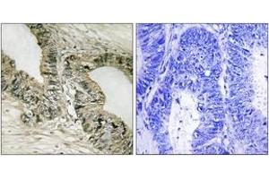 Immunohistochemistry analysis of paraffin-embedded human colon carcinoma tissue, using Gab2 (Ab-159) Antibody. (GAB2 anticorps  (AA 125-174))