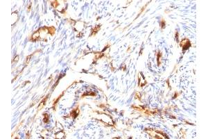 Formalin-fixed, paraffin-embedded human Endometrial Carcinoma stained with Beta-2-Microglobulin Mouse Monoclonal Antibody (B/1118)