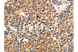 The image on the left is immunohistochemistry of paraffin-embedded Human liver cancer tissue using ABIN7191765(PAFAH1B1 Antibody) at dilution 1/25, on the right is treated with synthetic peptide. (PAFAH1B1 anticorps)