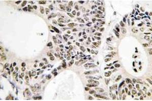 Immunohistochemistry (IHC) analyzes of p53 antibody in paraffin-embedded human colon carcinoma tissue. (p53 anticorps)