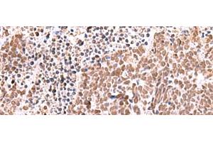 Immunohistochemistry of paraffin-embedded Human lung cancer tissue using RCOR3 Polyclonal Antibody at dilution of 1:60(x200) (RCOR3 anticorps)