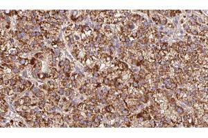 ABIN6279611 at 1/100 staining Human liver cancer tissue by IHC-P. (GPM6A anticorps  (Internal Region))
