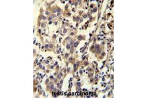 CCDC110 Antibody (C-term) immunohistochemistry analysis in formalin fixed and paraffin embedded human testis carcinoma followed by peroxidase conjugation of the secondary antibody and DAB staining. (CCDC110 anticorps  (C-Term))