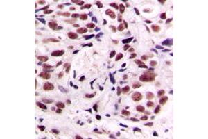 Immunohistochemical analysis of CREB (pS133) staining in human breast cancer formalin fixed paraffin embedded tissue section.