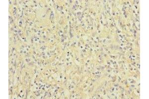 Immunohistochemistry of paraffin-embedded human lung cancer using ABIN7156472 at dilution of 1:100