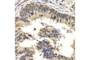 Immunohistochemistry of paraffin-embedded human colon carcinoma using RBBP5 antibody. (RBBP5 anticorps  (AA 319-538))
