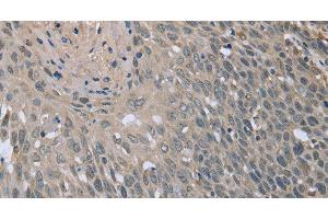 Immunohistochemistry of paraffin-embedded Human cervical cancer tissue using BMX Polyclonal Antibody at dilution 1:30 (BMX anticorps)