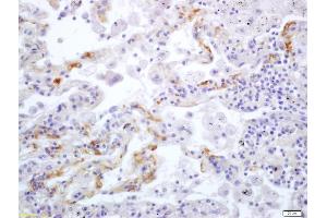 Formalin-fixed and paraffin embedded human lung carcinoma labeled with Anti Integrin alpha V/CD51 Polyclonal Antibody (ABIN678983), Unconjugated at 1:200, followed by conjugation to the secondary antibody and DAB staining (CD51 anticorps  (AA 51-150))