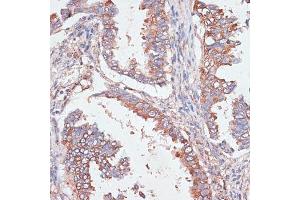 Immunohistochemistry of paraffin-embedded human lung cancer using G antibody  at dilution of 1:100 (40x lens). (GAB1 anticorps  (AA 1-150))
