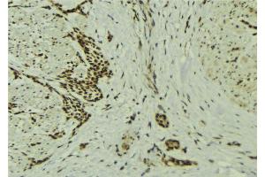 ABIN6273229 at 1/100 staining Human breast cancer tissue by IHC-P. (DOM3Z anticorps  (Internal Region))