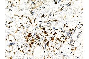 ABIN6263418 and ABIN6276466 at 1/100 staining Human pancreatic cancer by IHC-P. (MTAP anticorps  (Internal Region))