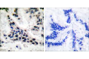 Peptide - +Immunohistochemical analysis of paraffin-embedded human lung carcinoma tissue using HDAC1 antibody (#C0221). (HDAC1 anticorps)