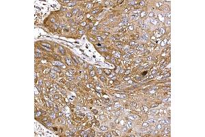 Immunohistochemistry of paraffin-embedded human esophageal cancer using DYNC1LI2 Rabbit pAb (ABIN7266863) at dilution of 1:25 (40x lens).
