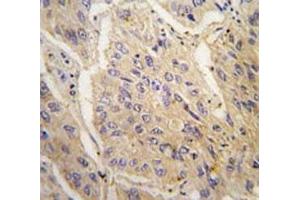 IHC analysis of FFPE human lung carcinoma tissue stained with anti-Caspase-3 antibody