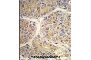 Formalin-fixed and paraffin-embedded human hepatocarcinoma tissue reacted with the SS antibody (Center) (ABIN389270 and ABIN2839403) , which was peroxidase-conjugated to the secondary antibody, followed by DAB staining.