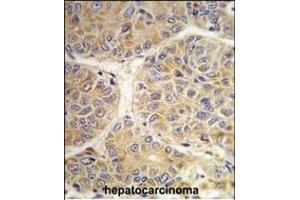 Formalin-fixed and paraffin-embedded human hepatocarcinoma tissue reacted with the SS antibody (Center) (ABIN389270 and ABIN2839403) , which was peroxidase-conjugated to the secondary antibody, followed by DAB staining. (AASS anticorps  (AA 264-294))