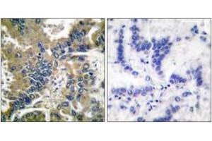 Immunohistochemistry analysis of paraffin-embedded human lung carcinoma tissue, using IL-1 beta (Cleaved-Asp210) Antibody. (IL-1 beta anticorps  (Cleaved-Asp210))