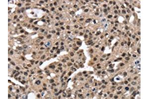 The image on the left is immunohistochemistry of paraffin-embedded Human breast cancer tissue using ABIN7130904(RNF40 Antibody) at dilution 1/25, on the right is treated with fusion protein. (RNF4 anticorps)