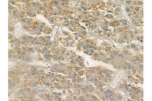 ABIN6256678 and ABIN6267101 at 1/100 staining human hepatocellular carcinoma by IHC-P.