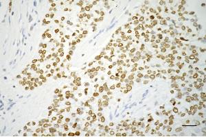 Immunohistochemistry was performed on paraffin-embedded human breast carcinoma using PARP antibody (ABIN7799867), 1:200).