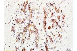 Formalin-fixed and paraffin embedded human breast carcinoma tissue labeled with Anti-BRMS-1 Polyclonal Antibody, Unconjugated at 1:200 followed by conjugation to the secondary antibody and DAB staining