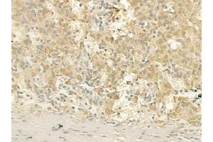 ABIN6257676 and ABIN6275499 at 1/100 staining human melanoma by IHC-P.