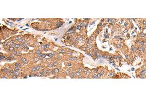 Immunohistochemistry of paraffin-embedded Human liver cancer tissue using ATP5C1 Polyclonal Antibody at dilution of 1:55(x200)