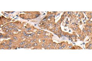 Immunohistochemistry of paraffin-embedded Human liver cancer tissue using ATP5C1 Polyclonal Antibody at dilution of 1:55(x200) (ATP5C1 anticorps)