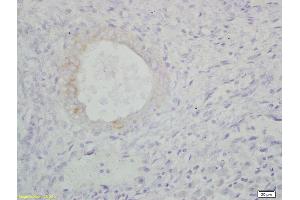 Formalin-fixed and paraffin embedded human endometrium carcinoma labeled with Anti-100-A9/MRP14/CFAG/Calgranulin B Polyclonal Antibody, Unconjugated (ABIN749288) at 1:200, followed by conjugation to the secondary antibody and DAB staining (S100A9 anticorps  (AA 51-114))
