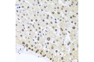 Immunohistochemistry of paraffin-embedded human liver injury using FUBP1 antibody at dilution of 1:100 (x40 lens). (FUBP1 anticorps)