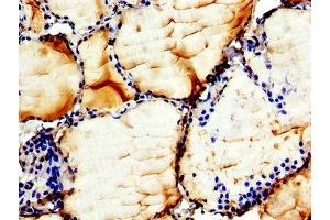 IHC image of ABIN7147628 diluted at 1:300 and staining in paraffin-embedded human thyroid tissue performed on a Leica BondTM system.