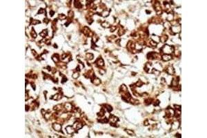 IHC analysis of FFPE human hepatocarcinoma tissue stained with the ZAK antibody