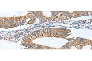 Immunohistochemistry of paraffin-embedded Human colorectal cancer tissue using CLEC1B Polyclonal Antibody at dilution of 1:60(x200) (C-Type Lectin Domain Family 1, Member B (CLEC1B) anticorps)