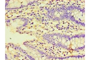 Immunohistochemistry of paraffin-embedded human colon cancer using ABIN7155929 at dilution of 1:100 (HSPBAP1 anticorps  (AA 1-488))