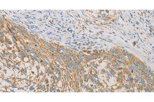 Immunohistochemistry of paraffin-embedded Human cervical cancer tissue using REN Polyclonal Antibody at dilution 1:40 (Renin anticorps)