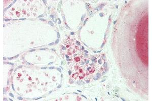 Rabbit Anti-PDE1A antibody Catalog Number: ARP53625 Formalin Fixed Paraffin Embedded Tissue: Human Thyroid Primary antibody Concentration: 1:100 Secondary Antibody: Donkey anti-Rabbit-Cy3 Secondary Antibody Concentration: 1:200 Magnification: 20x Exposure Time: 0. (PDE1A anticorps  (C-Term))