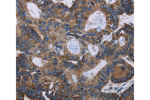 Immunohistochemistry of Human colon cancer using F11R Polyclonal Antibody at dilution of 1:60 (F11R anticorps)