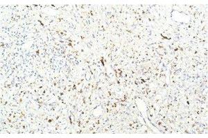 Immunohistochemistry of paraffin-embedded Human breast carcinoma tissue using JAK1 Monoclonal Antibody at dilution of 1:200. (JAK1 anticorps)