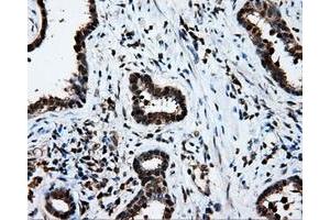 Immunohistochemical staining of paraffin-embedded Adenocarcinoma of ovary tissue using anti-LTA4H mouse monoclonal antibody. (LTA4H anticorps)