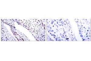 Immunohistochemical analysis of paraffin-embedded human breast carcinoma tissue using STAT3 (Ab-705) antibody (E021045). (STAT3 anticorps)