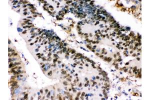 XRCC4 was detected in paraffin-embedded sections of human intestinal cancer tissues using rabbit anti- XRCC4 Antigen Affinity purified polyclonal antibody at 1 μg/mL.